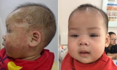 Bé 8 tháng tuổi biến chứng nặng do điều trị viêm da cơ địa sai cách, gia đình tá hỏa khi biết điều này