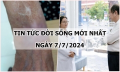 Tin tức đời sống ngày 7/7/2024: Người phụ nữ mắc bệnh lao da hiếm gặp
