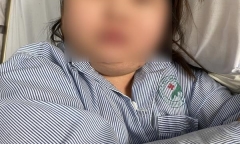Mặt và bụng to bất thường, cô gái trẻ phát hiện bị mắc hội chứng Cushing hiếm gặp