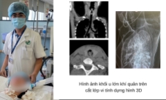 TP.HCM: Cứu sống bệnh nhân mắc khối u bít tắc khí quản hiếm gặp