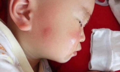 Bà nội chữa muỗi đốt theo cách lạ, cháu trai phải nhập viện cấp cứu gấp