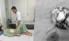 Kích hoạt báo động đỏ cứu thiếu niên ở Hà Nội có khối u gan nửa kg xâm lấn túi mật