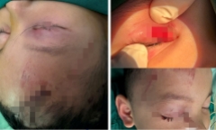 Bé trai 3 tuổi ở Nghệ An nhập viện khẩn cấp vì bị chó hàng xóm cắn trọng thương