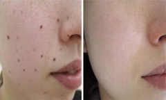 Xóa nhiều nốt ruồi cùng một lúc ảnh hưởng đến da như thế nào?