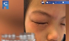 Bé gái dị ứng với bài tập toán: Cứ ngồi vào bàn là mắt sưng húp, ngứa ngáy phát khóc