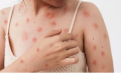 Bệnh nhân đầu tiên mắc đậu mùa khỉ tại Việt Nam là nữ, đi du lịch Dubai về