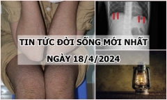 Tin tức đời sống ngày 18/4/2024: Cứu bé gái 8 tuổi bị thủng dạ dày vùng môn vị