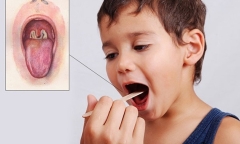 Thực hư thông tin TP.HCM xuất hiện ca bệnh bạch hầu