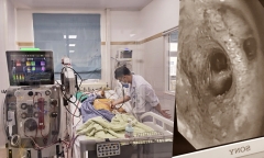 Hút ra nhiều sỏi đá và bùn đất từ phế quản nạn nhân bị lũ quét tại bản Làng Nủ
