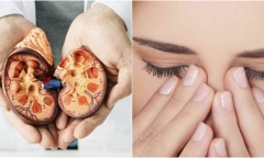 Ba triệu chứng ban đầu của suy thận mà nhiều người không để ý