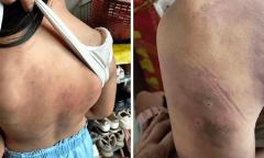 Vụ nữ sinh lớp 4 nhập viện, khủng hoảng vì bị bạn đánh hội đồng: Chủ tịch huyện chỉ đạo xử lý nghiêm 