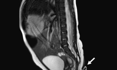 Hi hữu bé gái chào đời với chiếc đuôi dài gần 6cm