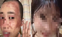Vợ bị chồng tạt axit vì lý do khó tin