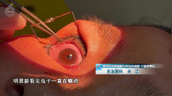 Hãi hùng phát hiện hơn 60 con sán được lấy ra từ mắt người phụ nữ