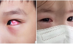 Bộ Y tế khuyến cao 5 biện pháp phòng chống đau mắt đỏ