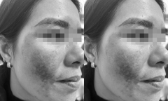 Trị nám đón Tết tại spa gần nhà, người phụ nữ bỏng toàn bộ khuôn mặt