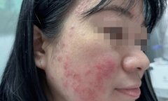 Hà Nội: Nữ sinh tin tưởng tiktok chữa mụn khiến mặt đỏ rát nguy cơ sẹo vĩnh viễn