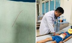 Bé trai 7 tuổi nuốt sợi dây cước 5cm mà gia đình không hề biết