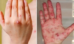 Dấu hiệu bệnh tay chân miệng chuyển nặng và biện pháp phòng bệnh mà phụ huynh cần biết