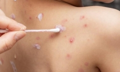 Ghi nhận thêm một ổ dịch thủy đậu tại trường mầm non ở Đắk Lắk