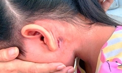 Nữ sinh ở Đắk Lắk được phát hiện mắc bệnh