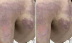 Đánh học sinh lớp 3 bầm tím người vì không làm được bài, cô giáo bị tạm đình chỉ
