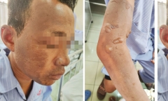Dùng xăng đốt rác, người đàn ông bị bỏng nặng vì lửa bùng vào người