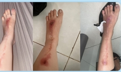 Đi tất niên cùng công ty, người phụ nữ bị bỏng do pháo hoa bắn trúng người
