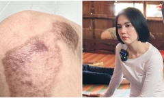 Ngọc Trinh ngậm ngùi chia sẻ tình trạng những vết thương sau 4 tháng gặp tai nạn lái xe mô tô