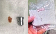 Hai nữ bệnh nhân hóc dị vật nguy hiểm sau bữa cơm, bác sĩ khuyến cáo gì?