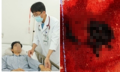 6 ca đột quỵ cấp cứu chỉ trong một đêm, tất cả là người trẻ tuổi