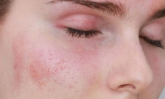 Những loại hạt tốt cho thận, nên ăn thường xuyên