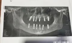 Cụ ông 77 tuổi tử vong sau cấy 6 implant và nhổ 12 răng