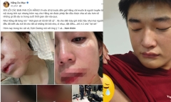 Toàn cảnh vụ Hằng Du Mục bị chồng đánh đập dã man, Dịch Dương bị thương vì lao vào bảo vệ