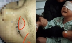 Giáo viên bôi mỡ lợn vào vết thương ở mắt khiến bé trai 4 tuổi bị mù vĩnh viễn tại Trung Quốc