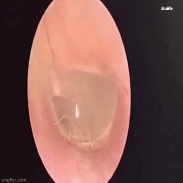 Video: Rợn người chứng kiến cảnh con nhện bò trong ống tai của người phụ nữ