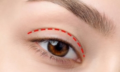 Làm đẹp theo xu hướng, cô gái phải sống chung với đôi mắt “không khép kín”