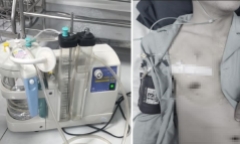 Tập đẩy tạ quá mức, nam thanh niên 25 tuổi tràn khí màng phổi nguy hiểm