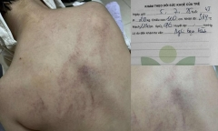 Vụ bé 4 tuổi nghi bị cô giáo bạo hành ở trường mầm non: Bộ Y tế vào cuộc, trưng cầu giám định