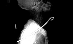 Vấp ngã trong lúc chăn bò, người đàn ông bị thanh sắt dài 30cm đâm xuyên cổ