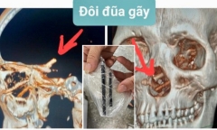 Bị bạn nhậu dùng đũa đâm xuyên mũi, 5 tháng sau mới phát hiện