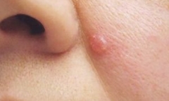 Tự điều trị nốt sần dưới cánh mũi 4 năm không khỏi, đi khám mới biết bị ung thư da