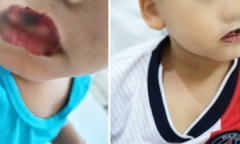 Bé 4 tuổi nghi bị hội chứng hiếm gặp 1 triệu người có 2 người mắc