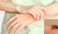 Nguy cơ Chikungunya xâm nhập Việt Nam: Chuyên gia cảnh báo nhưng khuyến nghị không hoang mang
