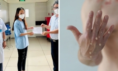 Bệnh nhân đậu mùa khỉ đầu tiên ở Bình Dương được ra viện