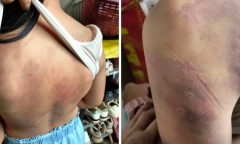 Vụ nữ sinh lớp 4 nhập viện, khủng hoảng vì bị bạn đánh hội đồng: Xót xa lời kể của người mẹ