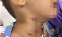 Chơi gần khi chó đang ngủ, bé trai 3 tuổi nhập viện với nhiều vết thương