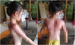 Vụ bé gái bị hàng xóm dội cả ấm nước sôi vào người: Tiết lộ tình tiết gây phẫn nộ 