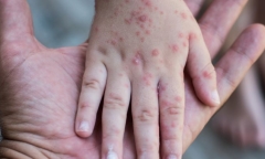 Ghi nhận ca đầu tiên nhiễm rubella ở Hà Nội năm 2024