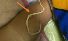  Bé trai 3 tuổi nôn ra dị vật, đến khi phẫu thuật bác sĩ càng bất ngờ bật ngửa